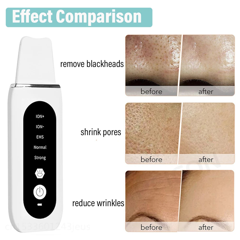 Ultrasonic Skin Scrubber & Blackhead Remover