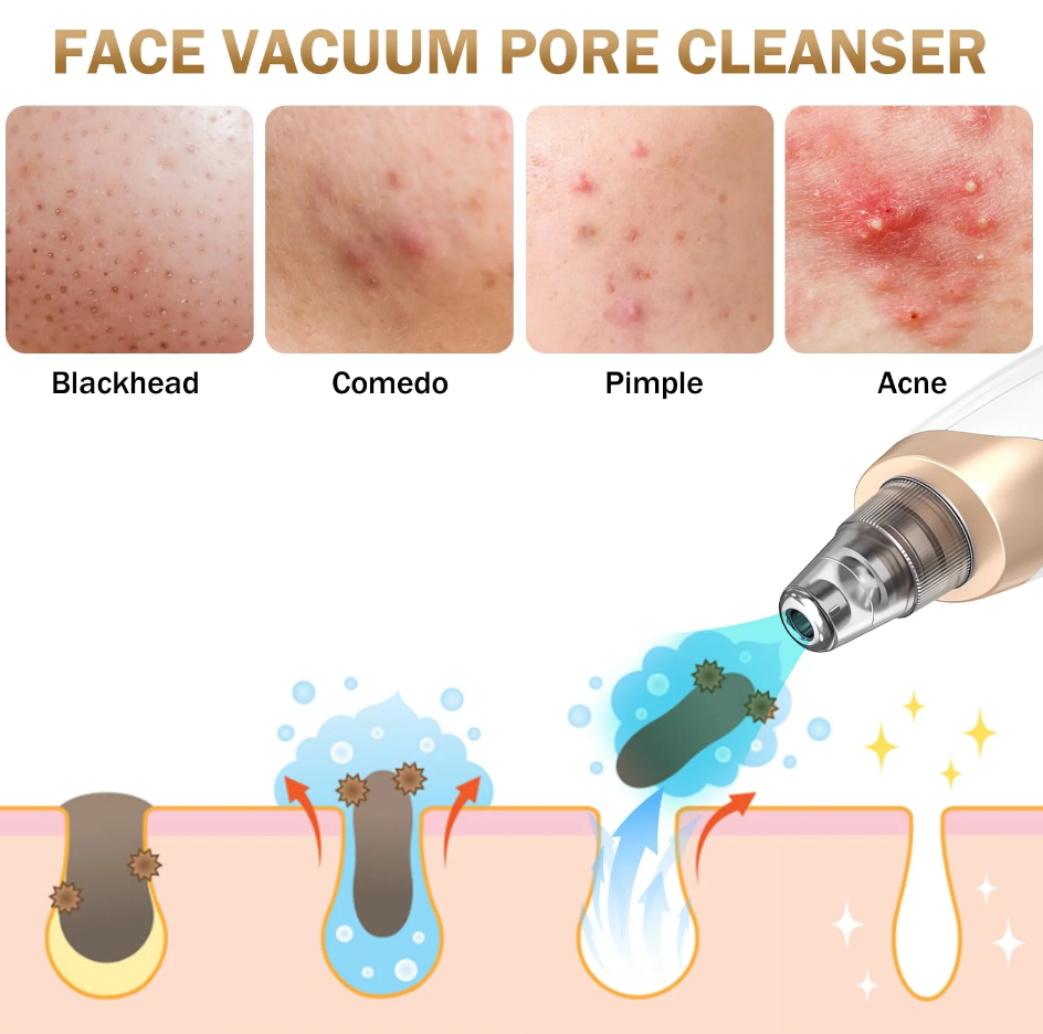 Facial Pore Vacuum for Blackhead & Acne Care