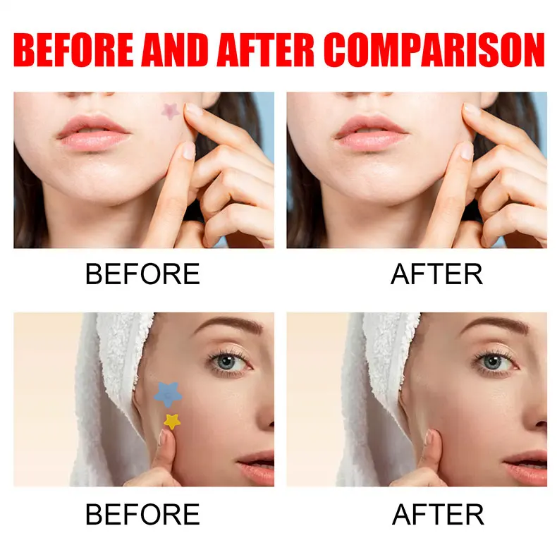 200x Acne Repair Patches for Clear Skin
